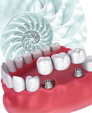 Dental Bridges